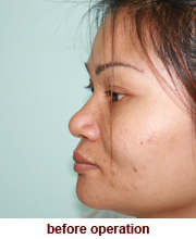 plastic_surgery_augmentation_rhinoplasty